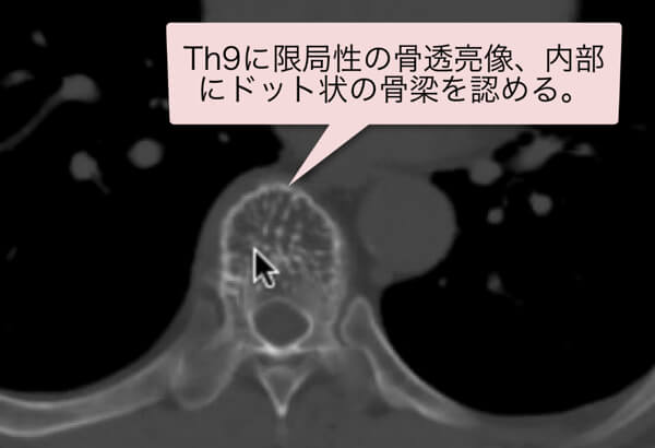 脊椎血管腫のCT,MRI画像診断(vertebral hemangioma)